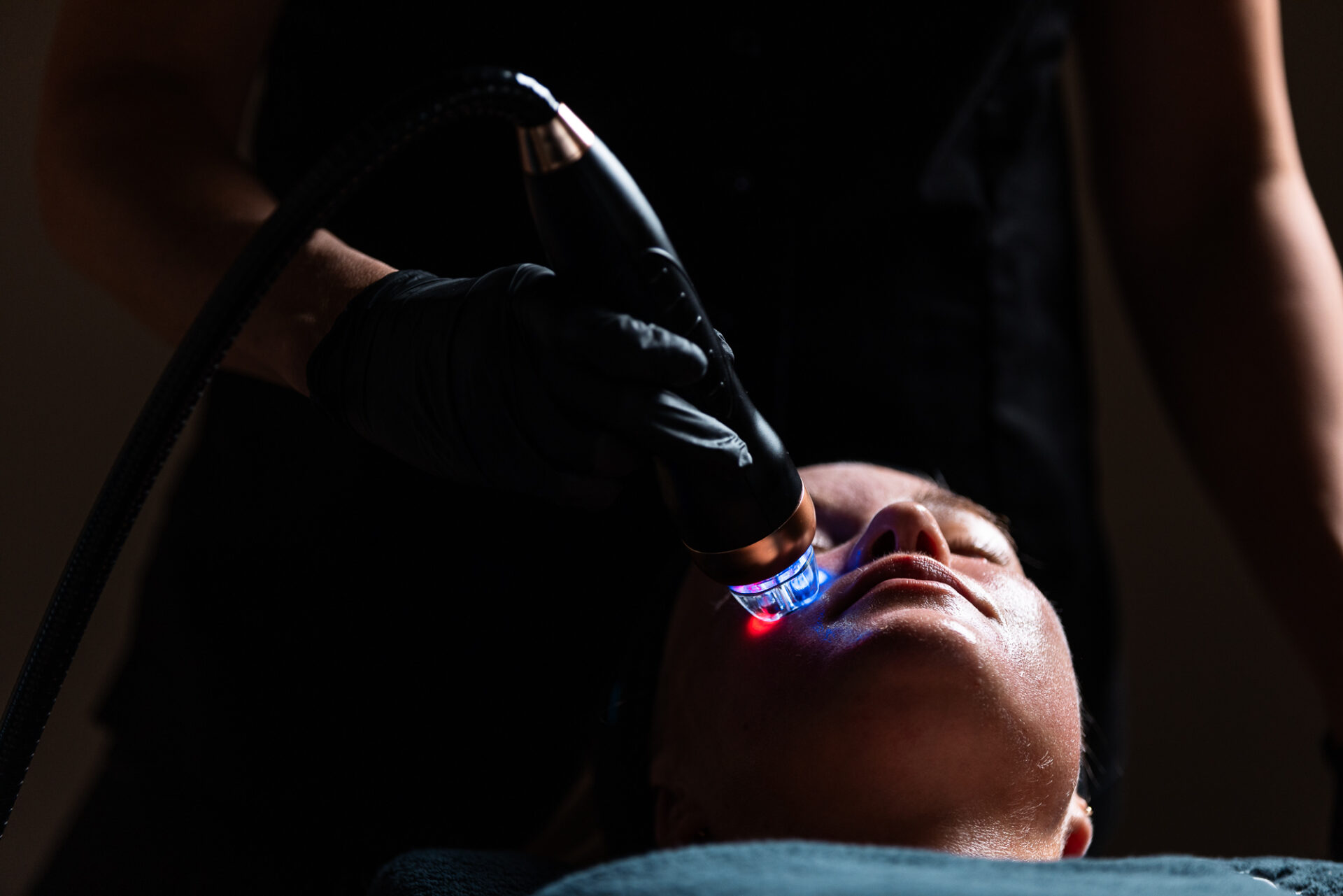 RF Microneedling-behandling med QRYO:s maskin