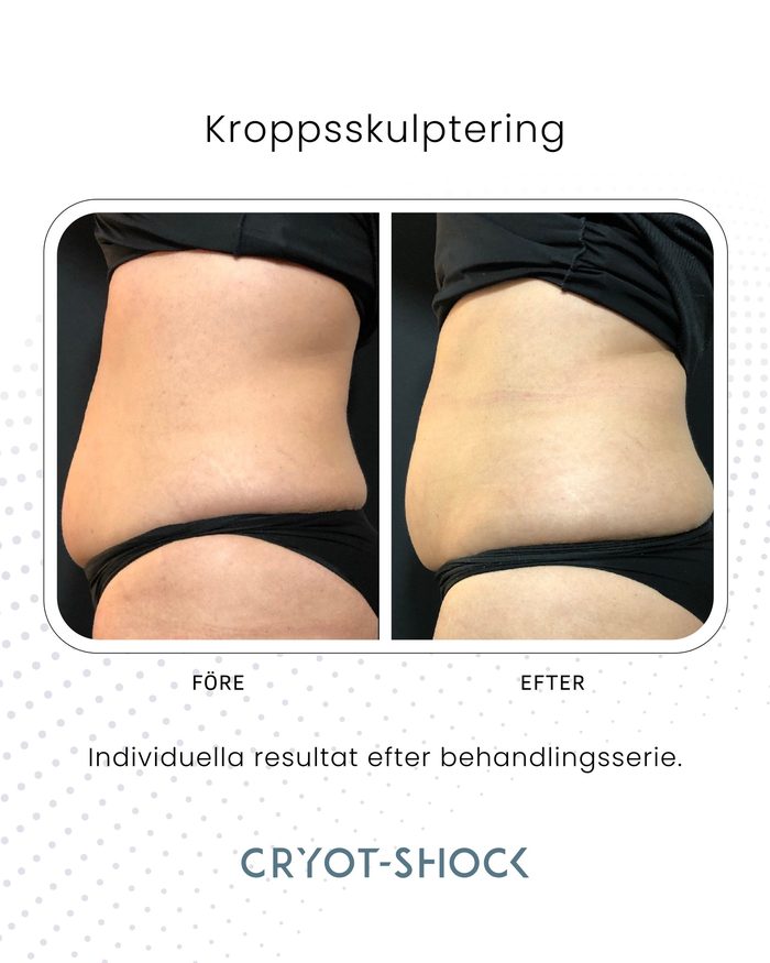 Cryo T-Shock före och efter – kroppsskulptering