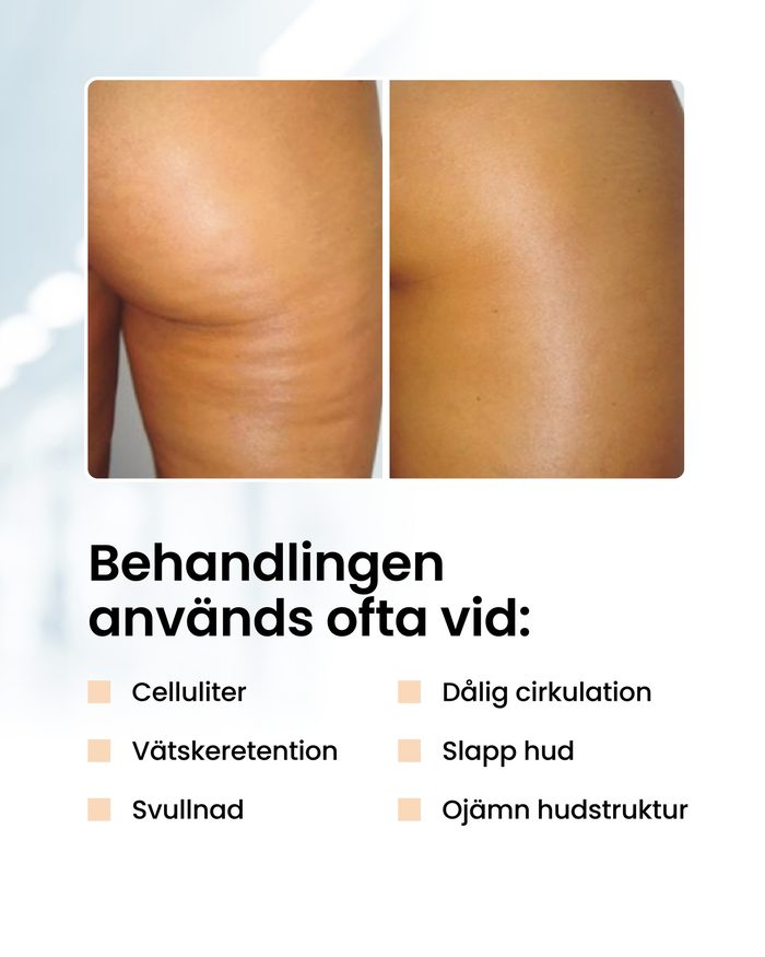 Endospheres före och efter – behandling av celluliter
